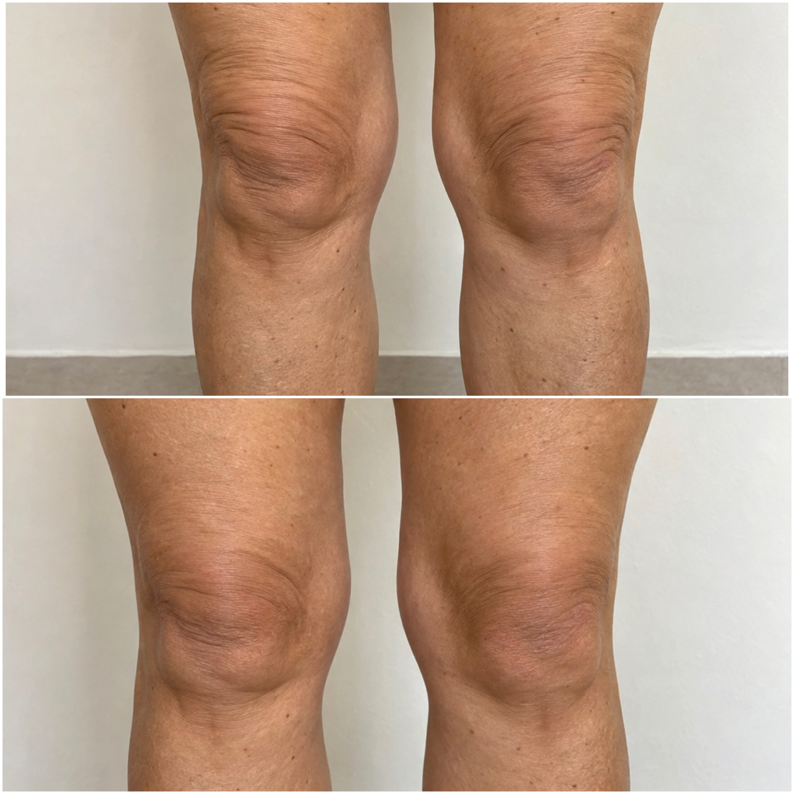 Clinical photograph collage. Endolift knee treatment; 10-month follow-up.