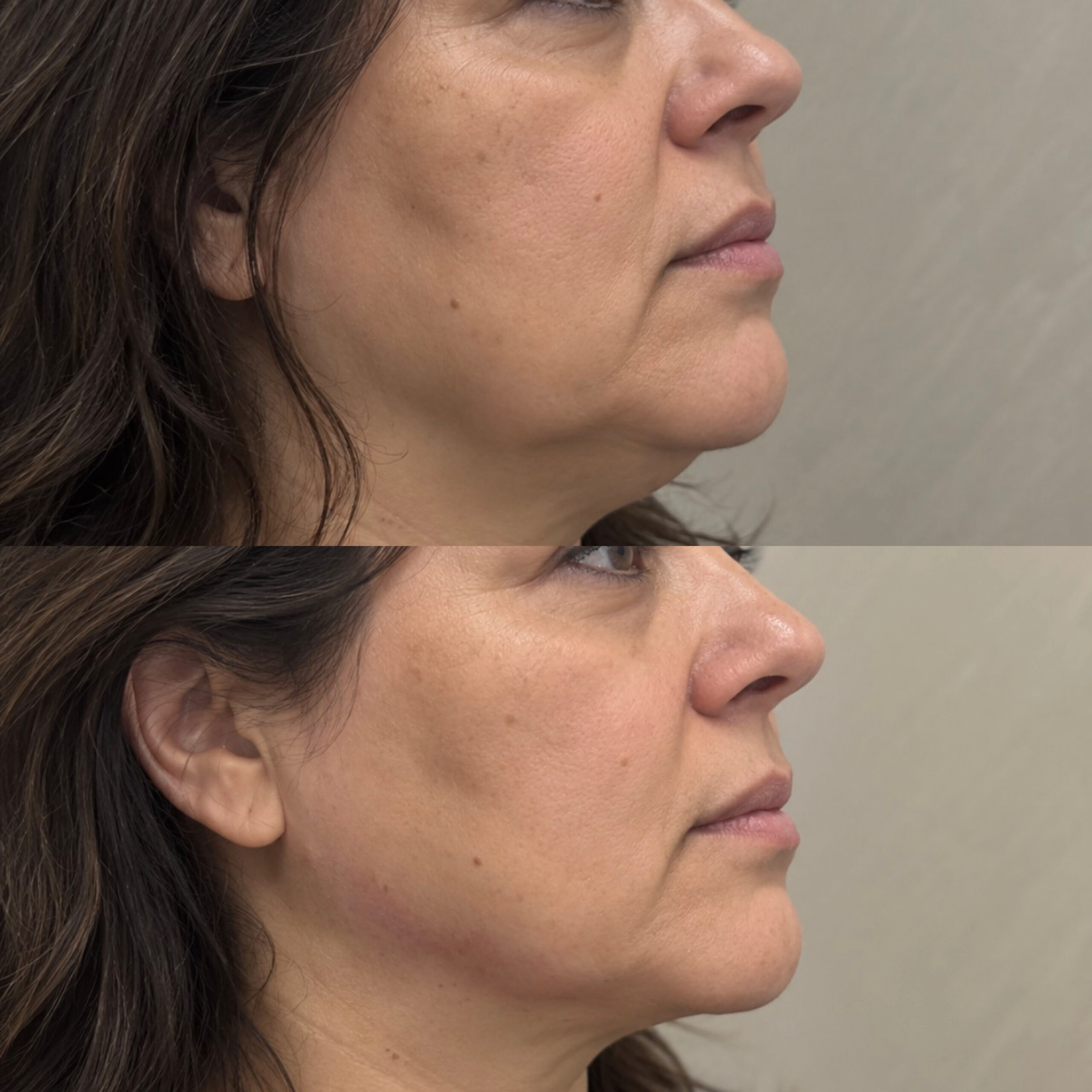 Clinical photograph collage. Endolift jawline treatment; 8-month follow-up.