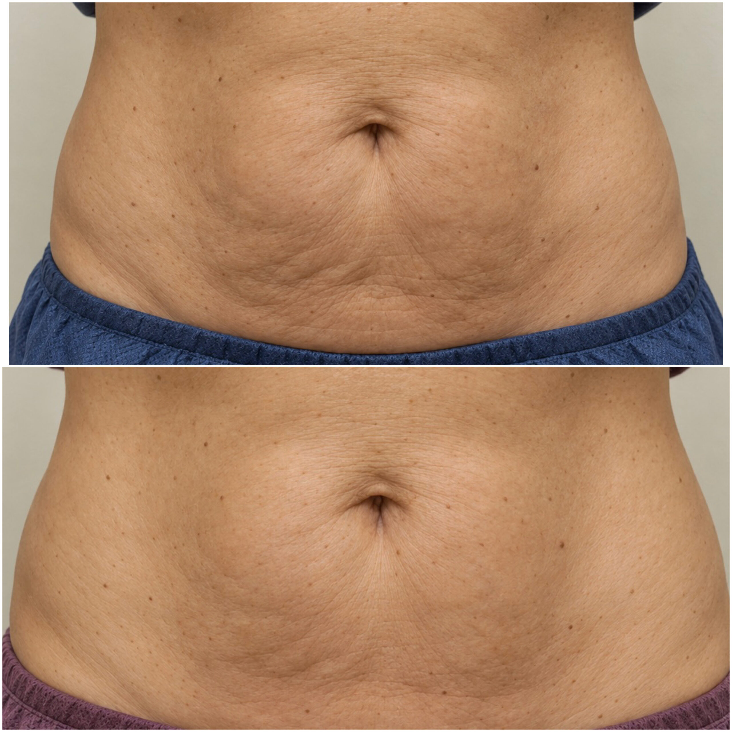 Clinical photograph collage. Endolift treatment; 6-month follow-up.