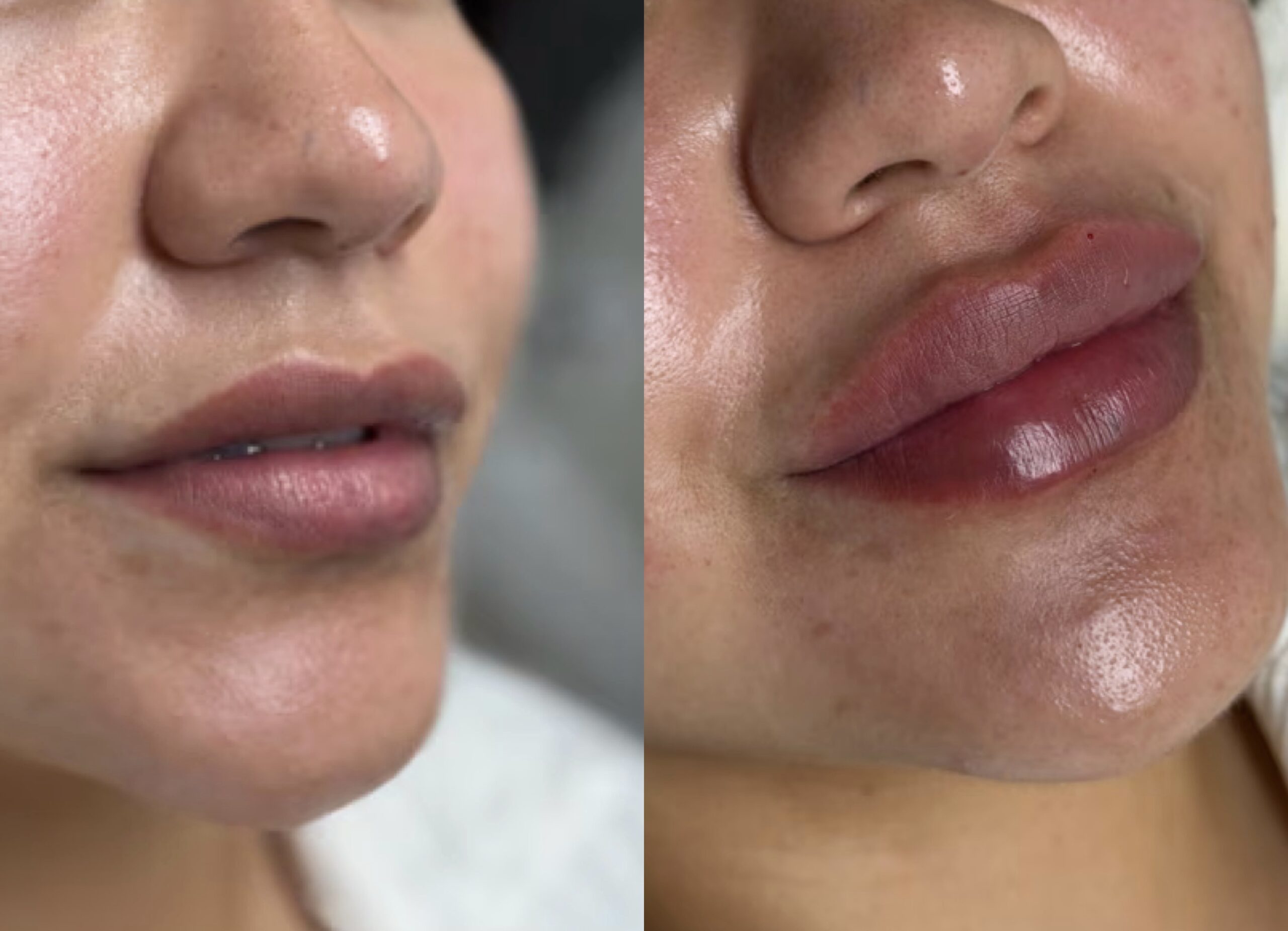 Clinical photograph collage. Lip filler treatment.