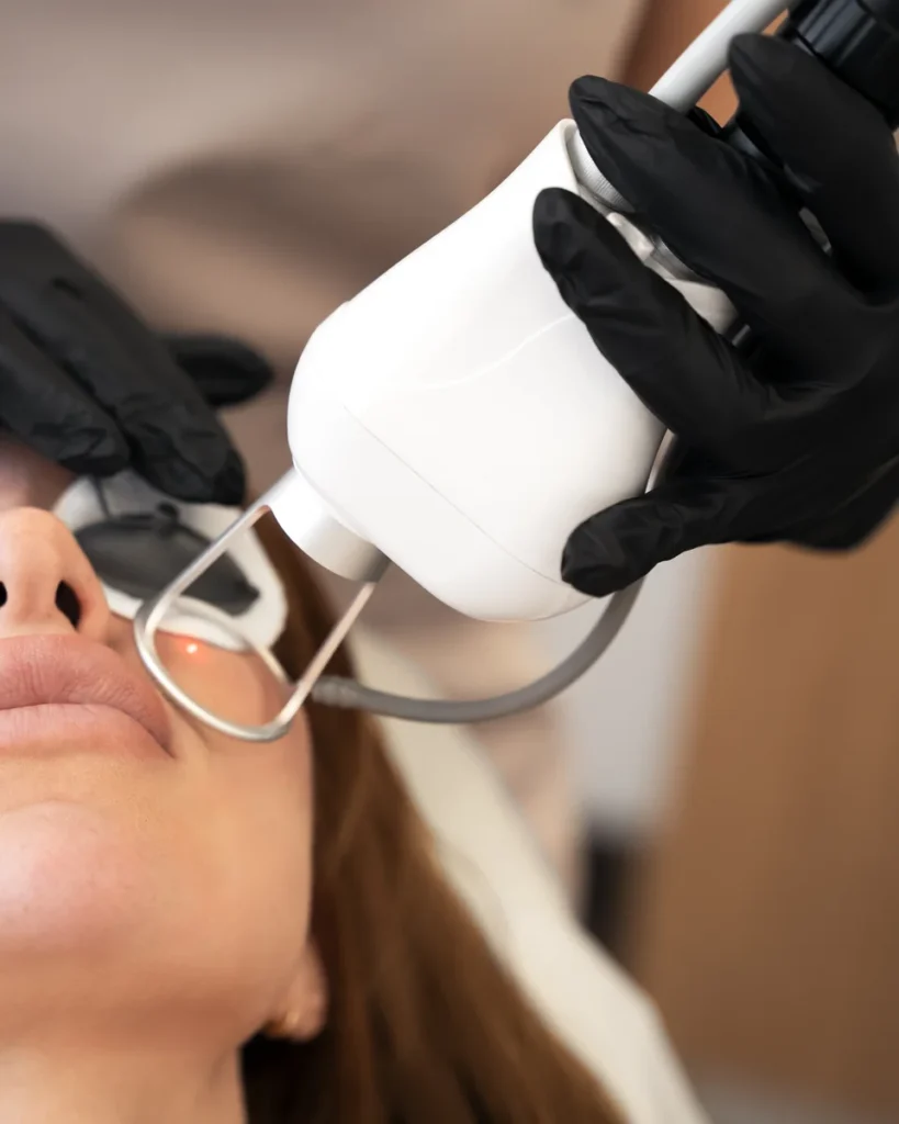 Close-up of a CO2 laser handpiece positioned at a woman’s cheek, with a protective eye shield in place.